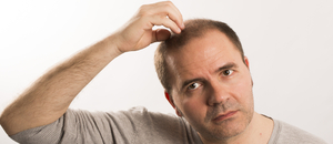 Alopecie a jak ji co nejlépe zvládnout ku prospěchu vlasové pokrývky hlavy